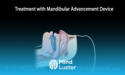 Snoring Obstructive Sleep Apnea and Treatment Animation