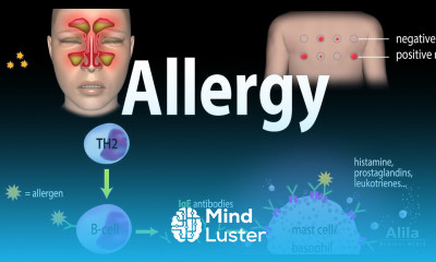 Allergy Mechanism Symptoms Risk factors Diagnosis Treatment and Prevention Animation