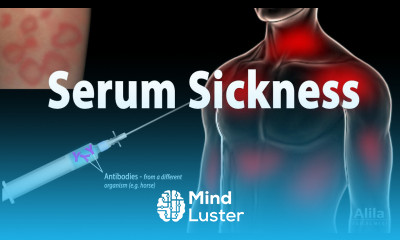 Serum Sickness Pathophysiology Symptoms Causes Treatment Animation