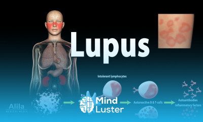 Lupus Symptoms Risk factors Pathophysiology Diagnosis and Treatments