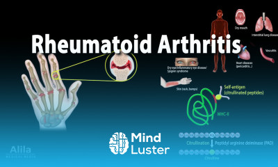 Rheumatoid Arthritis Animation