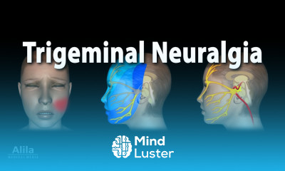 Trigeminal Neuralgia Tic Douloureux Animation