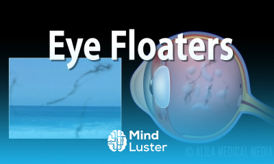 Eye Floaters and Flashes Animation