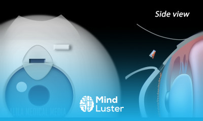 Trabeculectomy Surgery for Glaucoma Animation