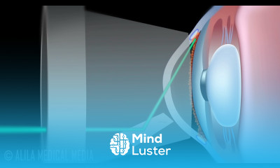 Laser Trabeculoplasty for Glaucoma ALT vs SLT Animation