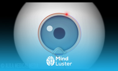 Canaloplasty Procedure for Glaucoma Animation