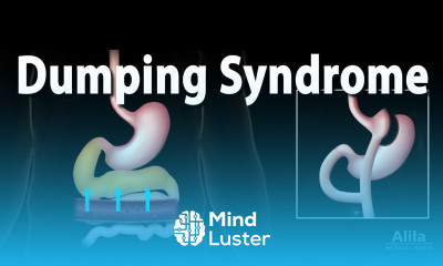 Dumping Syndrome Animation