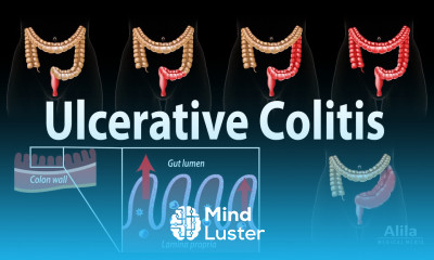 Ulcerative Colitis Pathophysiology Symptoms Risk factors Diagnosis and Treatments Animation