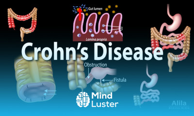 Crohn s Disease Pathophysiology Symptoms Risk factors Diagnosis and Treatments Animation