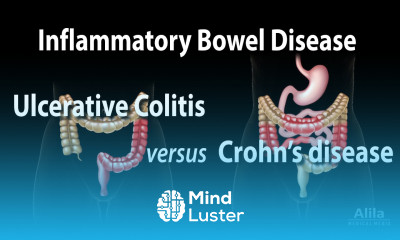 Ulcerative Colitis versus Crohn s Disease Animation