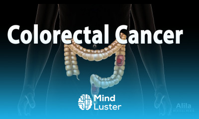 Colon Cancer Pathology Symptoms Screening Cause and Risk Factors Animation