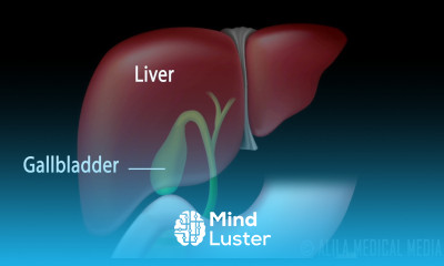 Gallstones and Surgical Removal of Gallbladder Cholecystectomy Animation