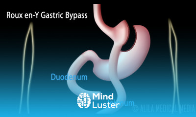 Roux en Y Gastric Bypass with Introduction on Body Mass Index Animation