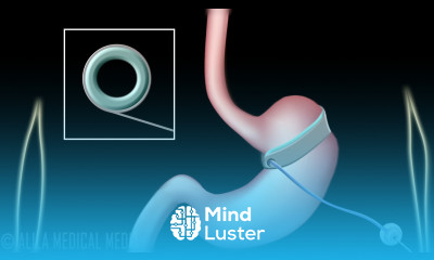 Gastric Sleeve and Lap Band Surgeries for Weight Loss Treatment Animation