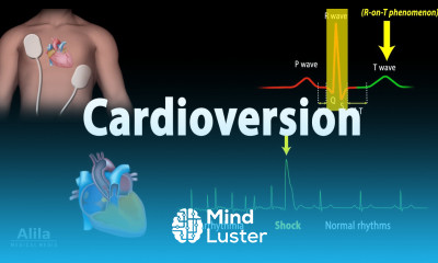 Cardioversion Electrical Procedure Animation