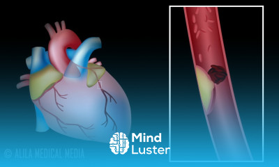 Myocardial Infarction and Coronary Angioplasty Treatment Animation