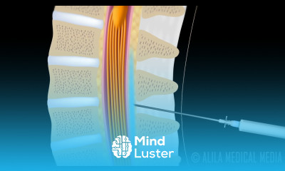 Lumbar Epidural Steroid Injection Animation