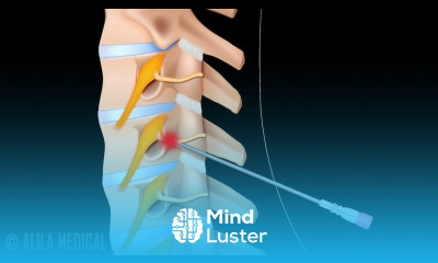 Cervical Radiofrequency Neurotomy Procedure