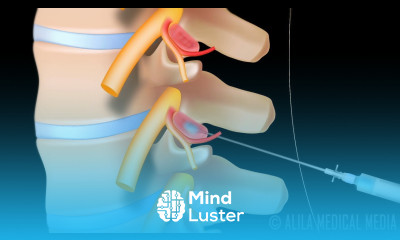 Lumbar Facet Joint Injection Procedure Animation