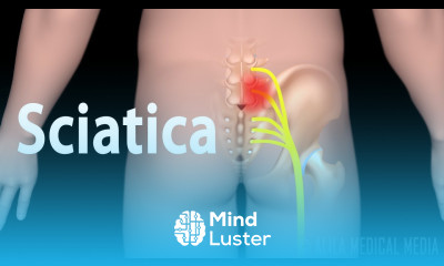 Sciatica signs and symptoms causes treatment animation