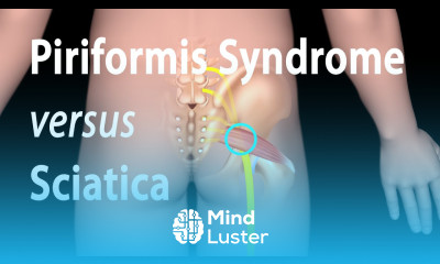 Piriformis Syndrome versus Sciatica Animation