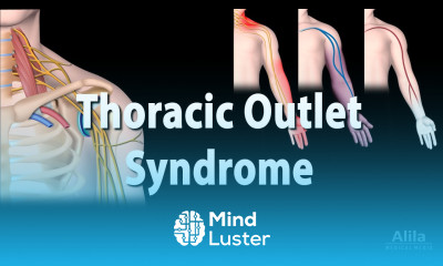 Thoracic Outlet Syndrome TOS Animation