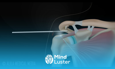 Subacromial Decompression and Arthroscopic Rotator Cuff Repair Animation