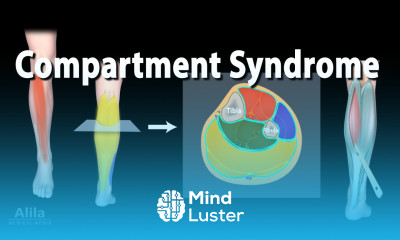 Compartment Syndrome Animation
