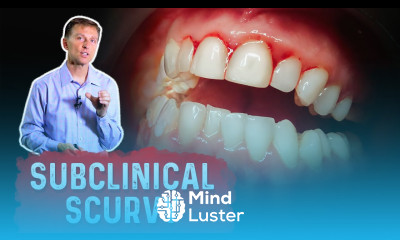 Vitamin C Deficiency Subclinical Scurvy – Causes Symptoms and Remedies – Dr Berg