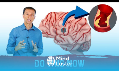 How to Avoid a Silent Stroke