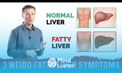 3 Weird Signs Symptoms Of Fatty Liver – Dr Berg