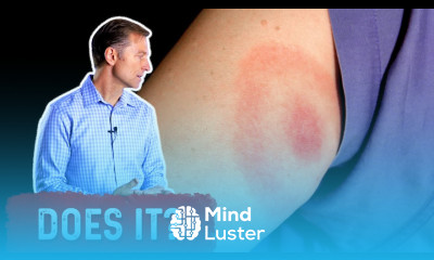 Does the Bullseye Rash Mean Lyme Disease