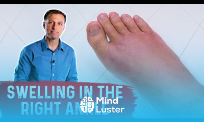 What Causes Right Ankle Edema