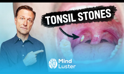 What CAUSES Tonsil Stones and How to Prevent Them