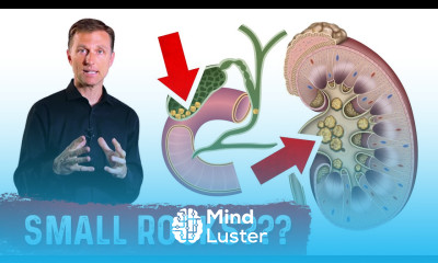 Why Do Stones Develop In Your Kidney and Gallbladder