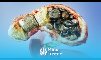 The FIRST Sign of Gallstones over 80 of the Time