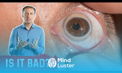 Why the White Ring Around Your Iris