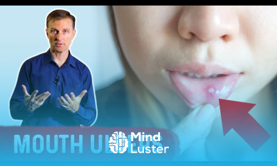 Natural Remedies for Mouth Ulcers OKAY