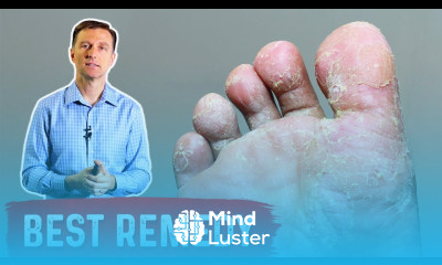 The Best Remedy for Athlete s Foot OKAY