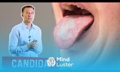 High Carb Diets and White Tongue Oral Thrush