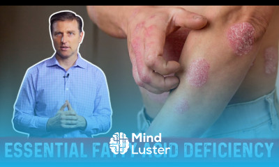 Fatty Acids Omega 3 and Omega 6 Deficiency Symptoms and Sources by Dr Berg