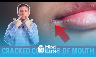 What Causes Cracked Corners of Mouth How to Get Rid of Angular Cheilitis – Dr Berg