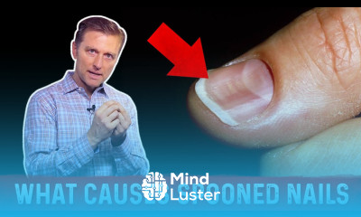 Spoon Nails Causes Treatments By Dr Berg