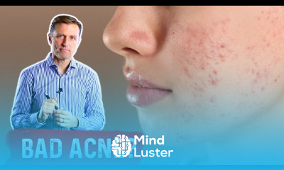 If Nothing is Working for Acne Try This Acne Removal Treatment – Dr Berg