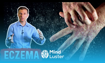 Use ACV Apple Cider Vinegar for Eczema