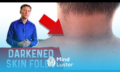 How to Reverse Acanthosis Nigricans