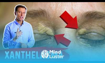 Yellow Bumpy Patches Around the Eyelids