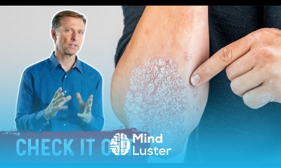 A Great Psoriasis Remedy