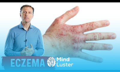 Unsuspecting Foods that Cause Eczema OKAY