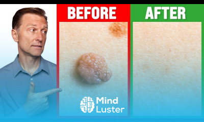 How to Rid Skin Tags and Warts Within 24 Hours Dr Berg on Skin Tag Removal